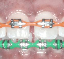 Braces and Power Chains - Orthodontic Associates