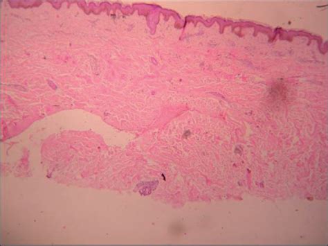 Significance of Histopathology in Leprosy Patients with 1-5 Skin ...