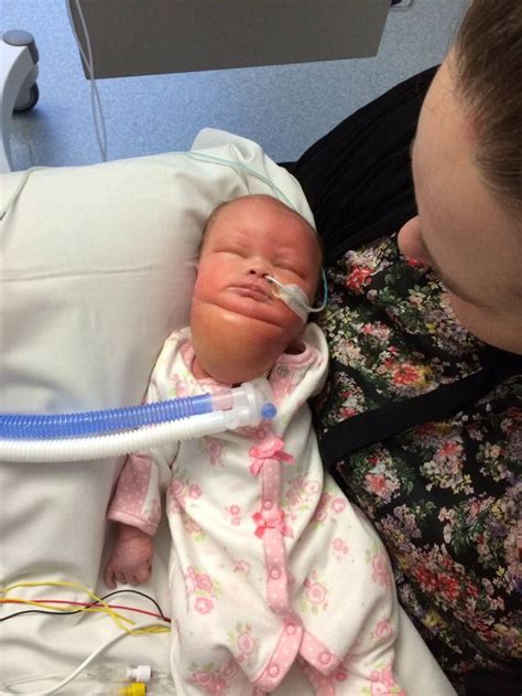 Baby Who Was Born With a Massive Neck Tumor Celebrates First New Year