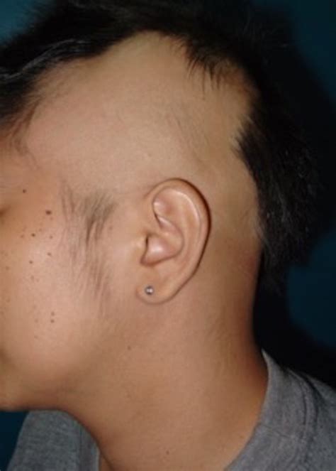 Alopecia areata. Non-inflammatory circular patch of hair loss on the ...