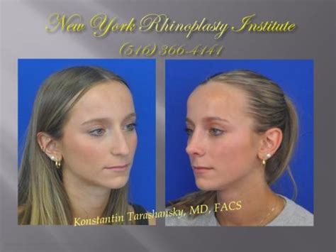 Patient Gallery | New York Rhinoplasty