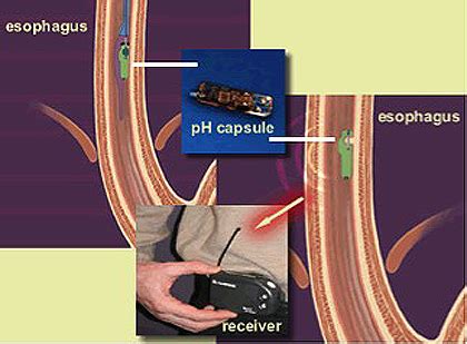 Bravo – pH STUDY « Athens Gastroenterology