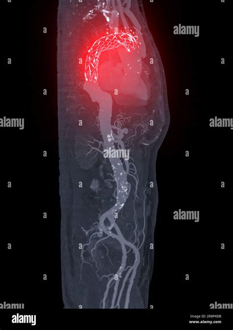 CTA whole aorta with thoracic aorta stent graft 3D rendering image in case abdominal aortic ...