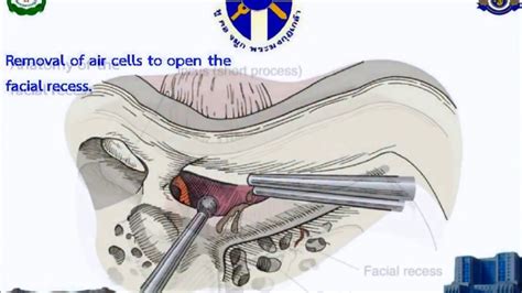 Mastoid Surgery 720p - YouTube