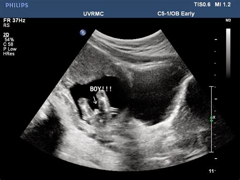 twin boys ultrasound 14 weeks 3 days - DrBeckmann