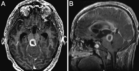 Preoperative MRI illustrating a 1.7 cm × 1.9-cm mass located in the... | Download Scientific Diagram