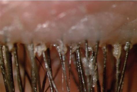 Demodex Blepharitis