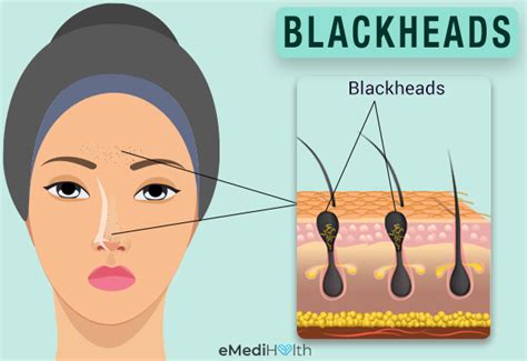 What Causes Blackheads and How to Treat Them