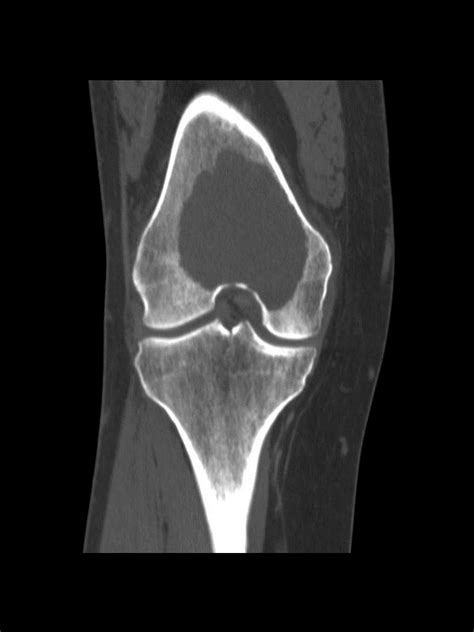 Giant cell tumor of bone - wikidoc