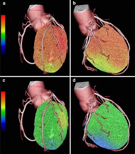 Three-dimensional cardiac hybrid PET-CT images of patient with angina ...