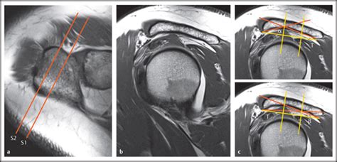 Shoulder Joint | Radiology Key