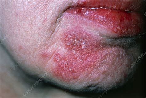 Facial rash of Systemic Lupus Erythematosus (SLE) - Stock Image M200 ...