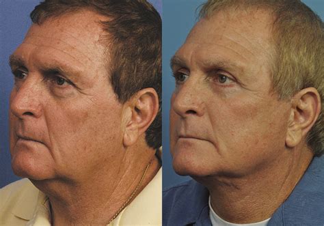 Male Neck Lift Jacksonville, FL | Ponte Vedra Beach Neck Lift