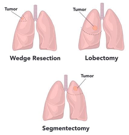 VATS/RATS Lung Resection | Mary Washington Healthcare