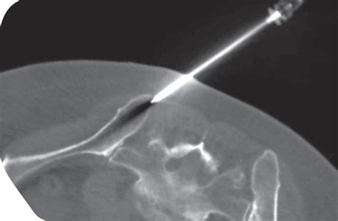 Arrow® OnControl® Powered Bone Lesion Biopsy System | LA | Teleflex