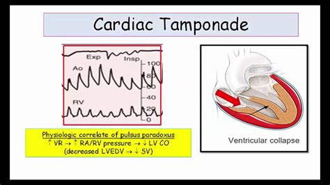 Jvp In Cardiac Tamponade