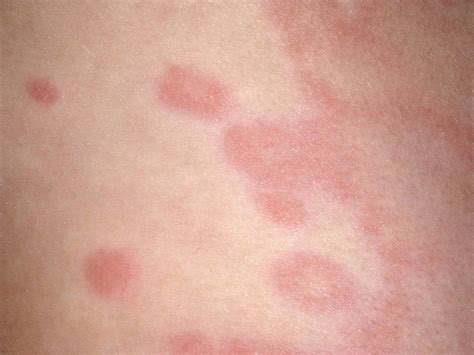 Childhood rashes, skin conditions and infections: photos - BabyCentre