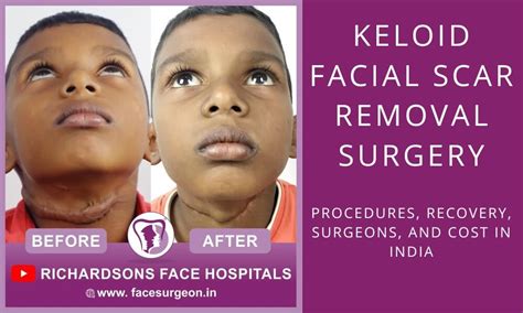 Keloid Facial Scar Removal | Procedures, Recovery, Surgeons, and Cost in India – Richardson's ...