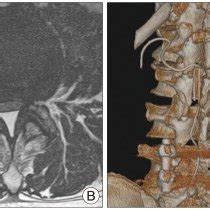 A and B : Sagittal and axial T2-weighted MRI show an extensive epidural... | Download Scientific ...