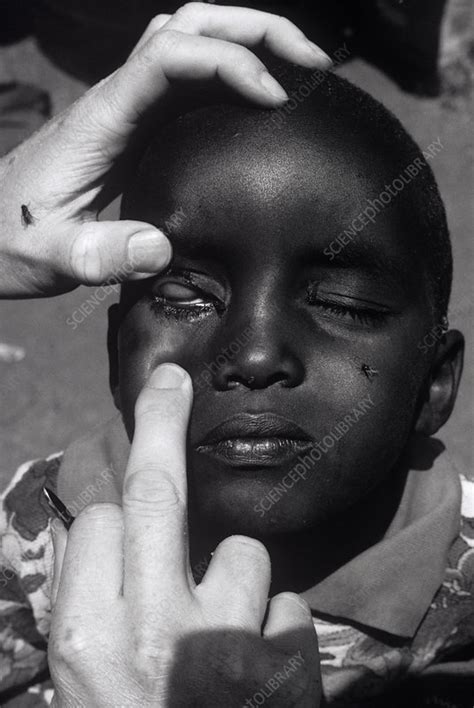 Trachoma eye infection treatment - Stock Image - M935/0291 - Science Photo Library