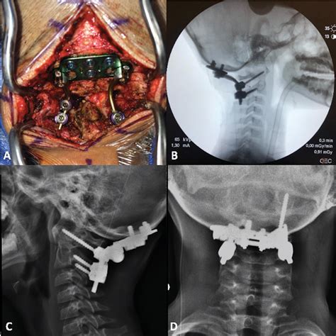 [PDF] Traumatic Atlanto-occipital Dislocation in Children Followed by Hydrocephalus – A Case ...