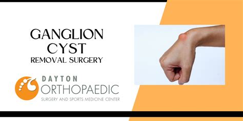 Ganglion Cyst Removal – Dayton Orthopaedic Surgery