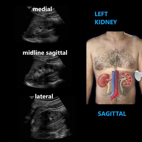 Renal Ultrasound Complete Protocol – Sonographic Tendencies