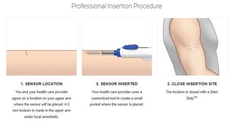 All About the Eversense XL Continuous Glucose Monitor (CGM) – Diabetes Daily