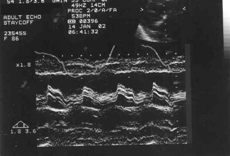 Types of ultrasonography - The physics behind ultrasounds