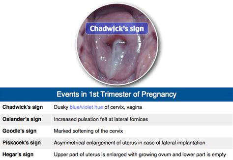 Chadwicks Sign