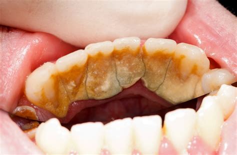 Scaling & Polishing – Wisdom Dental Surgery