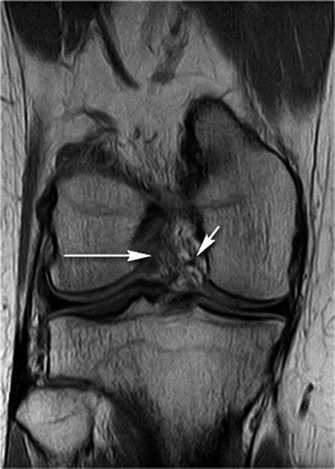 Right Knee Acl Tear Mri / The ABCs of Al Harrington's Torn ACL | Golden ...