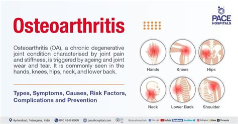 Osteoarthritis: Symptoms, Causes, Risk Factors, Complications