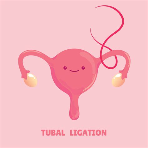 tubal ligation medical procedure vector illustration 29325557 Vector Art at Vecteezy