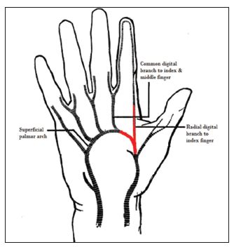 Schematic depicting the normal superficial palmar arch anatomy | Download Scientific Diagram