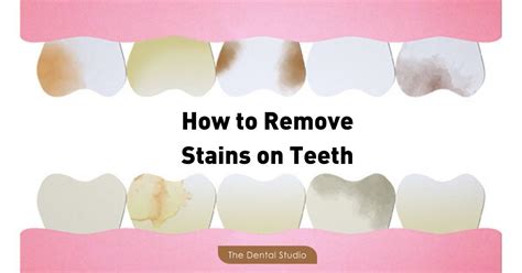 Common Causes of Stains on Teeth and How to Treat Them | The Dental Studio