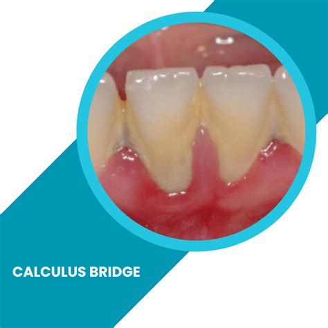 Calculus Bridge - What is a Calculus Bridge?