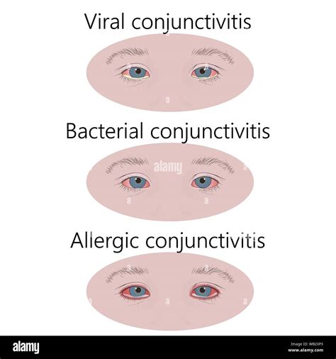 Types of conjunctivitis, illustration. Comparison of allergic ...