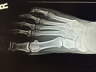 Hallux Rigidus X Ray