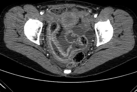 Ileum : Endoscopy Terminal Ileum Normal Finding Doccheck / The ileum ...