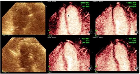 Safety of SF6(SonoVue®) Contrast Agent on Pharmacological Stress ...