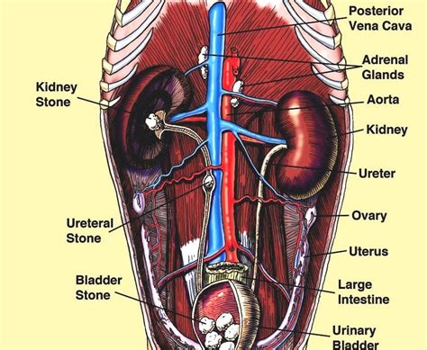 Bladder Stone - Human Bladder Stones