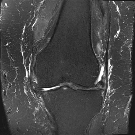 osteoarthritis of the knee | pacs