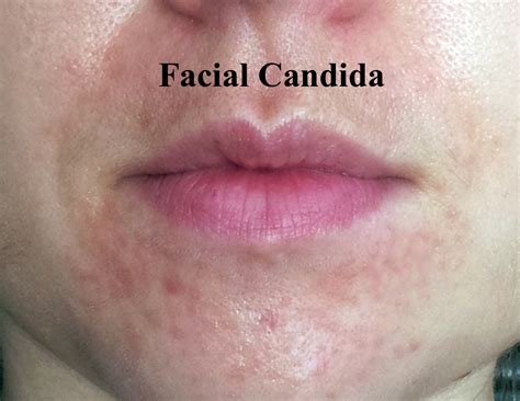 Candida of the skin: facial yeast and how it can occur - LEA EIGARD