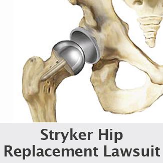 Stryker Hip Lawsuits Consolidated In NJ Grow To Almost 2,100 Allege ...