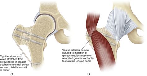 8 Lateral Advancement of the Greater Trochanter | Musculoskeletal Key