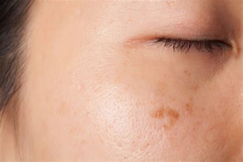 What Causes Brown Spots on the Skin? - Beverly Hills MD