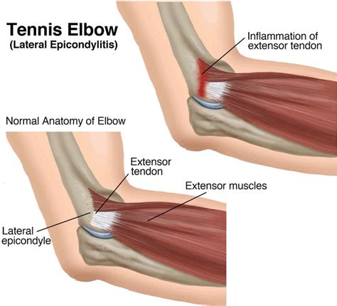 Blog | Tennis Elbow - It's Not Just For Athletes