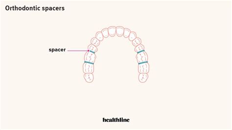 Spacers for Braces: How They’re Used, If They Hurt, and Oral Care