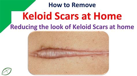 Keloid Scars What Are They And How To Prevent Them – Otosection